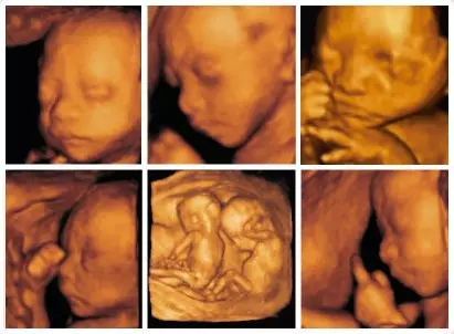 上海四维彩超：孕妇四维彩超的重要性？